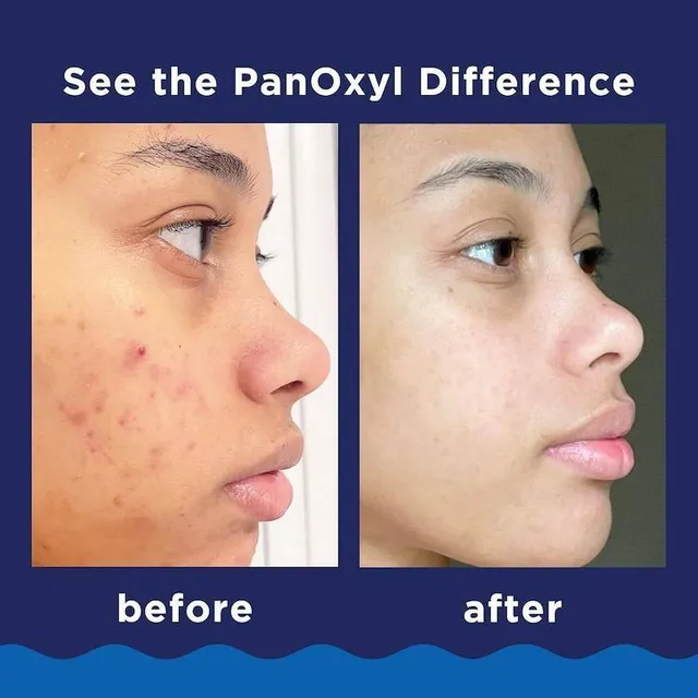 فوم شوینده ضد آکنه صورت و بدن پنوکسیل PanOxyl Acne Foaming Wash Benzoyl Peroxide 10% حجم 156میل (208) - تصویر 3