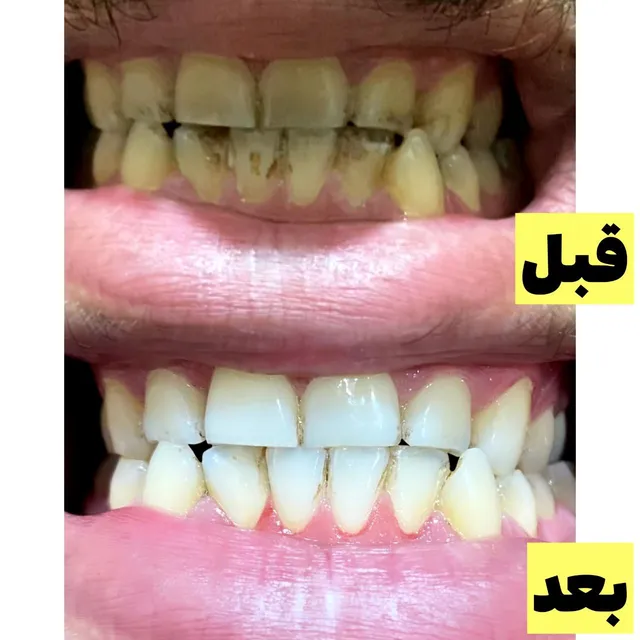 جرمگیر و سفید کننده دندان لاورا (LAVERA) - تصویر 3