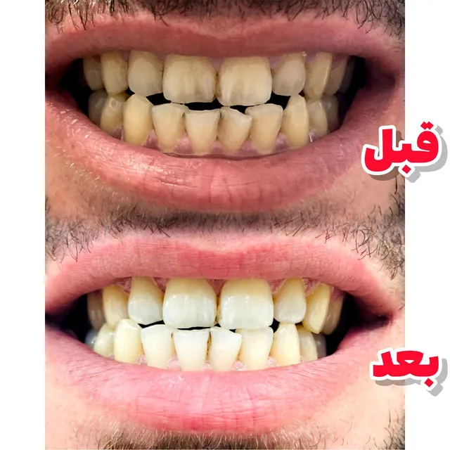جرمگیر و سفید کننده دندان لاورا (LAVERA) - تصویر 5